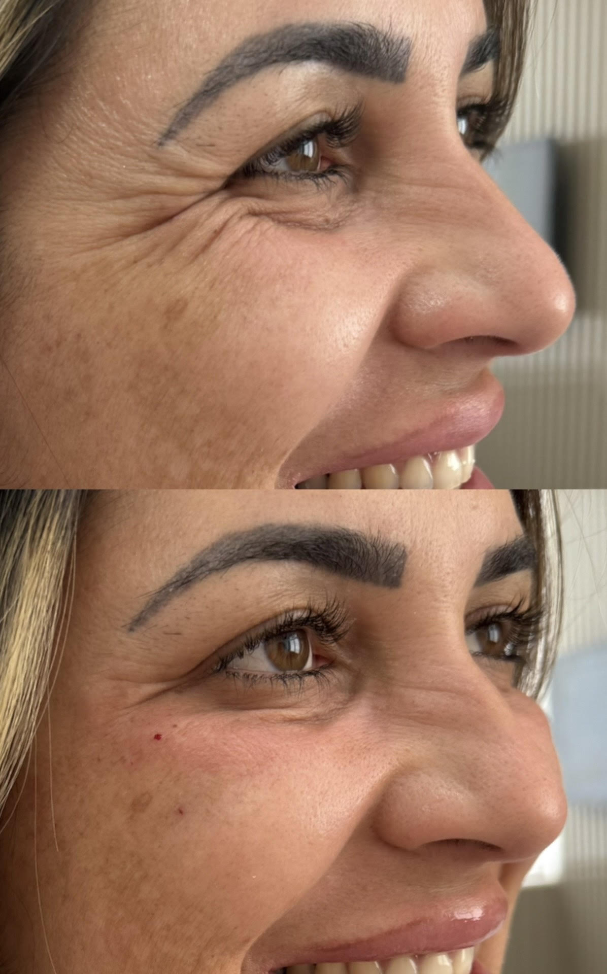 Resultado de Skinbooster Restylane